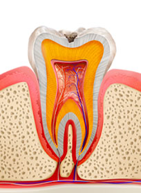 エナメル質だけ損傷した虫歯