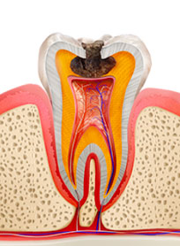 エナメル質と象牙質が損傷した虫歯