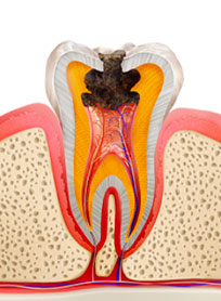 神経まで炎症ができた虫歯