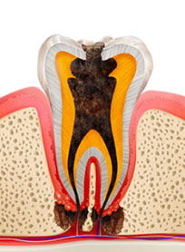 根まで炎症が広がった虫歯